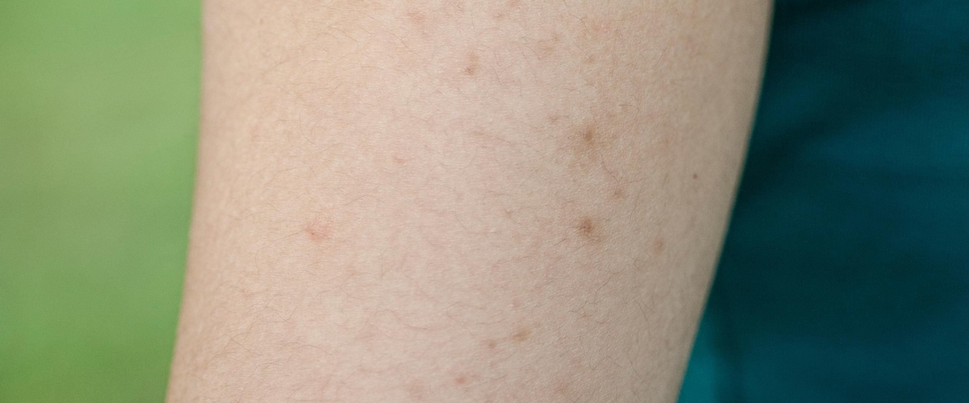 Will laser hair removal help keratosis pilaris?